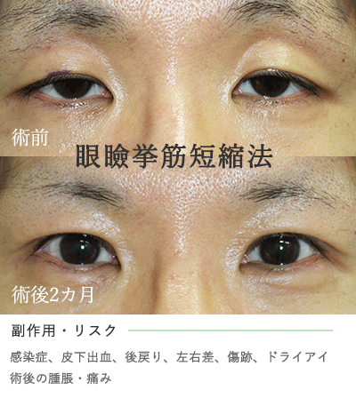 眼瞼下垂の治療 眼瞼挙筋短縮法とは